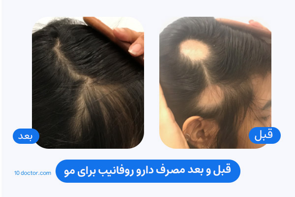 قبل و بعد مصرف دارو روفانیب برای مو