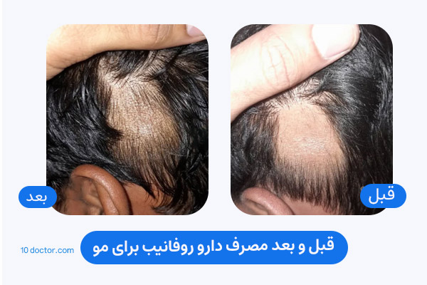 قبل و بعد مصرف دارو روفانیب برای مو
