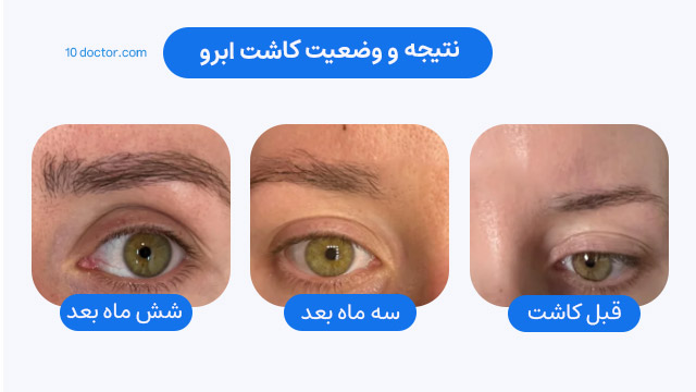 نتیجه و وضعیت کاشت ابرو