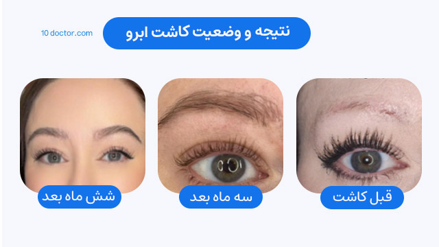 نتیجه و وضعیت کاشت ابرو
