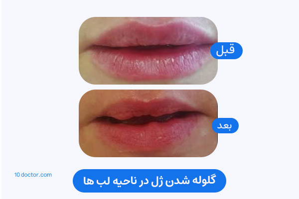 گلوله شدن ژل در ناحیه لب ها