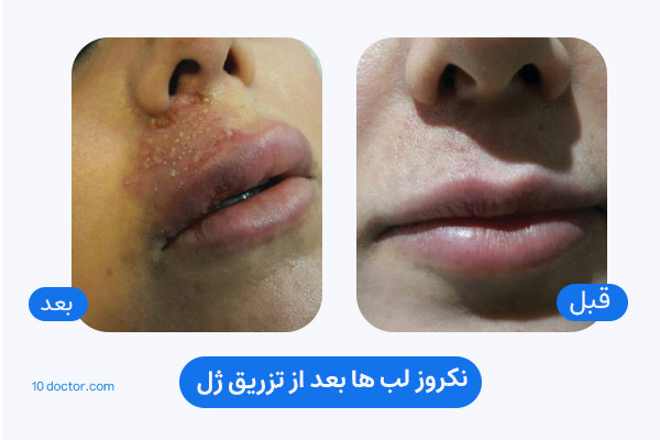 نکروز و عفونت لب ها بعد از تزریق ژل 