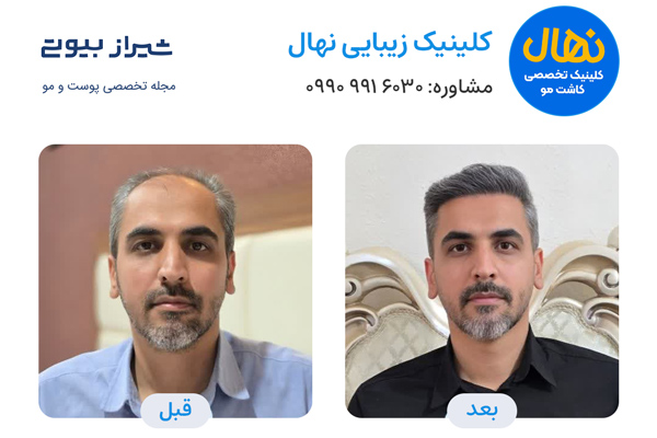 کاشت مو در شیراز - کلینیک نهال