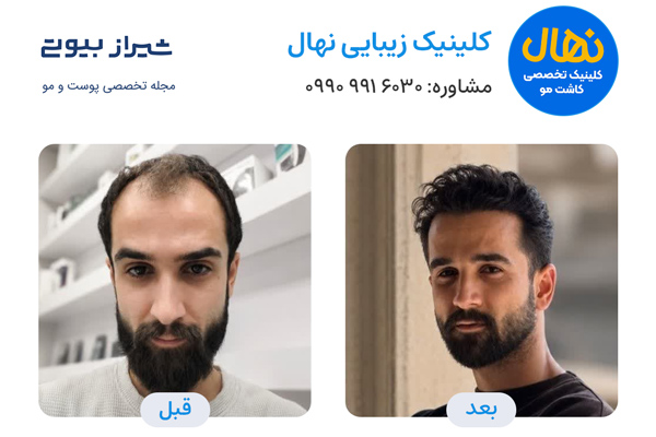 کاشت مو در شیراز - کلینیک نهال