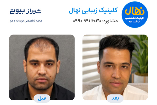 کاشت مو در شیراز - کلینیک نهال