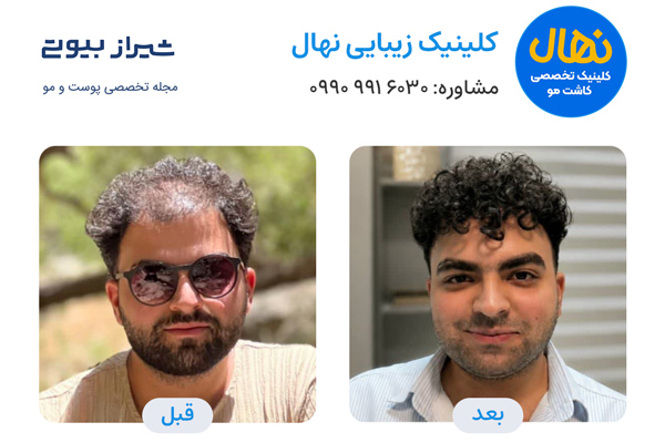 کاشت مو در شیراز - کلینیک نهال