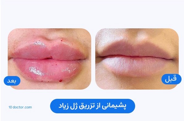 پشیمانی از تزریق ژل لب زیاد