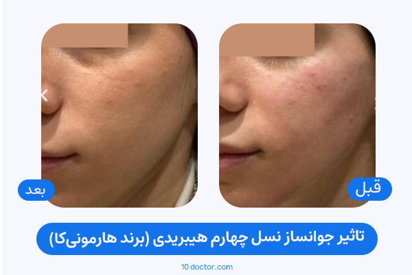 تاثیر جوانساز نسل چهارم هیبریدی (برند هارمونی‌کا)