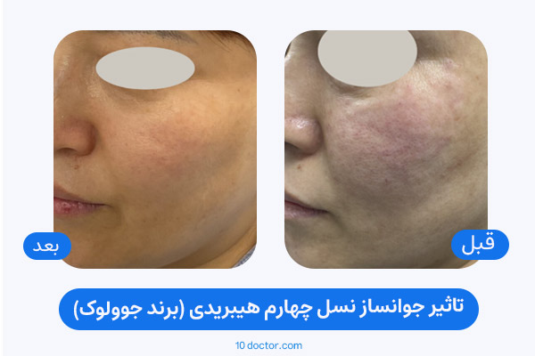 تاثیر جوانساز نسل چهارم هیبریدی (برند جوولوک)
