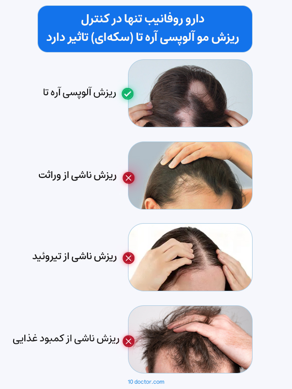 دارو روفانیب تنها در کنترل ریزش مو آلوپسی آره تا (سکه‌ای) تاثیر دارد.
