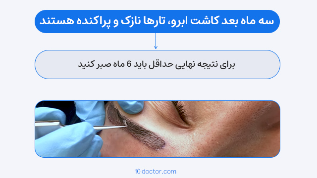 سه ماه بعد کاشت ابرو، تارها نازک و پراکنده هستند. 