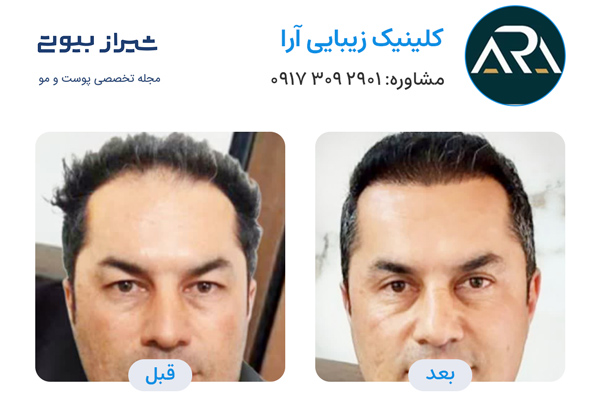 کاشت مو در شیراز - کلینیک تخصصی آرا