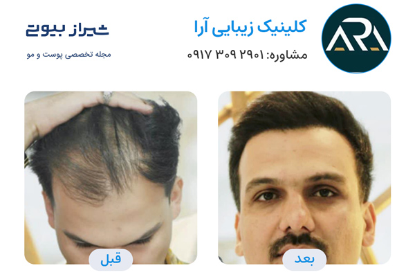 کاشت مو در شیراز - کلینیک تخصصی آرا