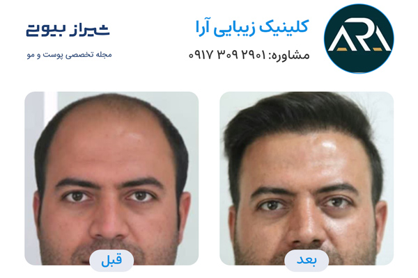 کاشت مو در شیراز - کلینیک تخصصی آرا