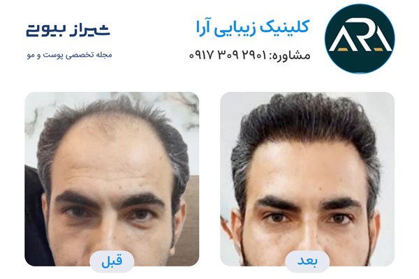 کاشت مو در شیراز - کلینیک تخصصی آرا
