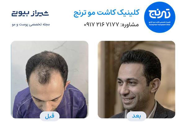 تصویر قبل و بعد کاشت مو در شیراز - کلینیک ترنج