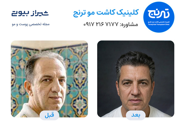 نتایج کاشت موی دوستان در شیراز