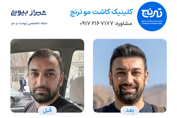 قبل و بعد کاشت مو شیراز کلینیک ترنج