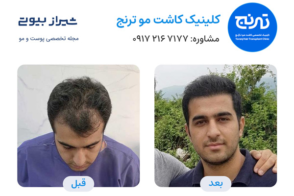 تصویر قبل و بعد کاشت مو در شیراز