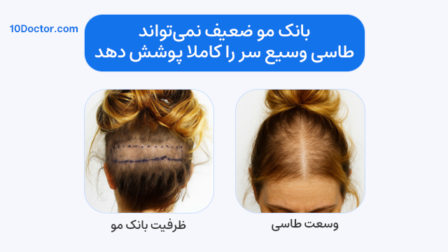 بانک مو ضعیف نمی‌تواند طاسی وسیع سر را کاملا پوشش دهد. 