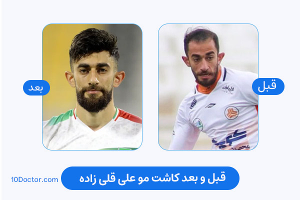 علی قلی زاده قبل کاشت مو - بعد از کاشت مو