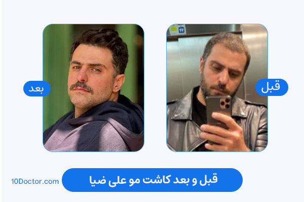 کاشت مو علی ضیاء