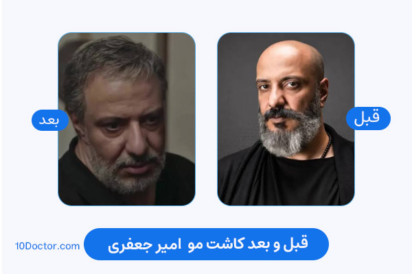 کاشت مو امیر جعفری