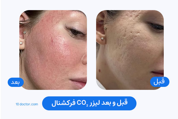 قبل و بعد لیزر CO2 فرکشنال