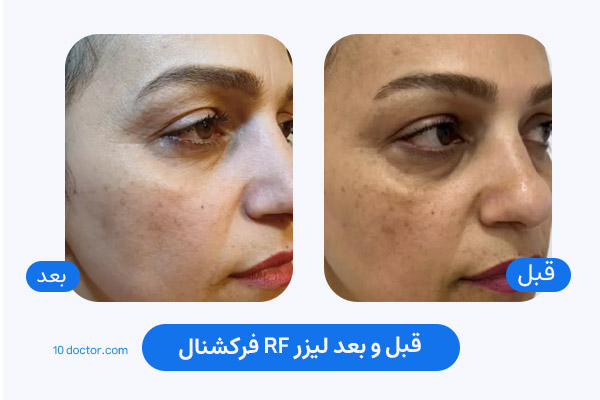 قبل و بعد لیزر RF فرکشنال