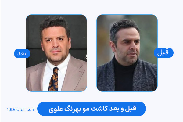 کاشت مو بهرنگ علوی