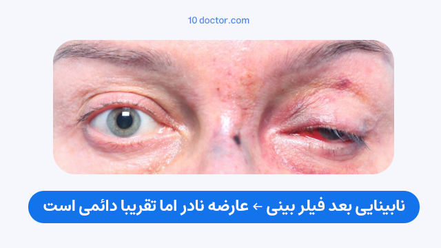 نابینایی بعد فیلر بینی ← عارضه نادر اما تقریبا دائمی است.
