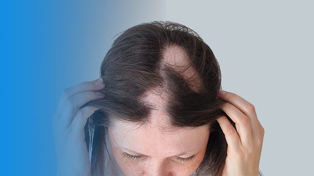 ایا ریزش مو سکه ای خوب میشود ؟