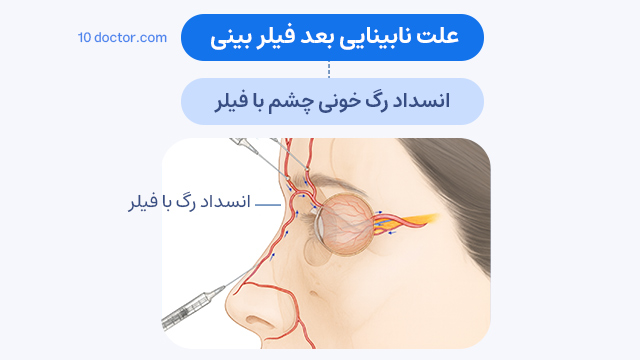 علت نابینایی بعد فیلر بینی ← انسداد رگ خونی چشم با فیلر
