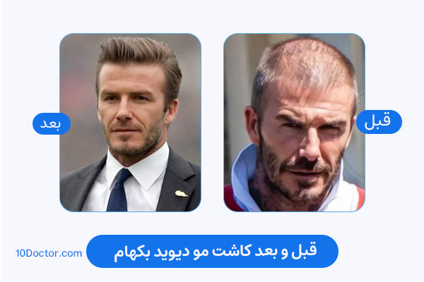 دیوید بکهام قبل کاشت مو - بعد از کاشت مو