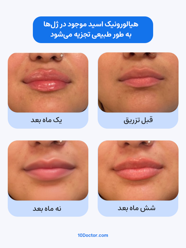 تزریق ژل حدود 6 تا 9 ماه اثر حجم‌دهندگی دارد و به مرور تجزیه می‌شود.
