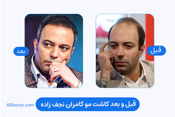 کاشت مو کامران نجف زاده