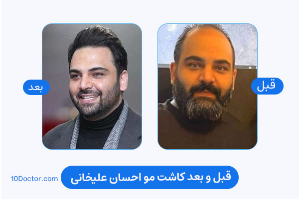 کاشت مو احسان علیخانی