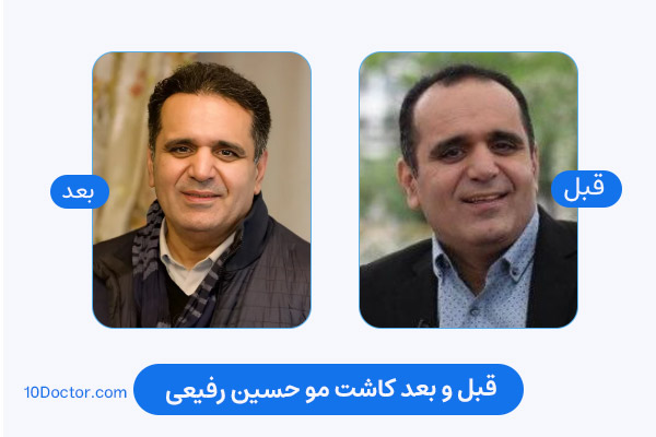 کاشت مو حسین رفیعی