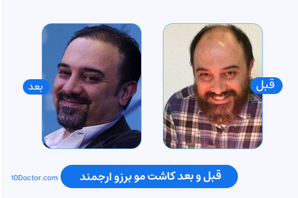 کاشت مو برزو ارجمند