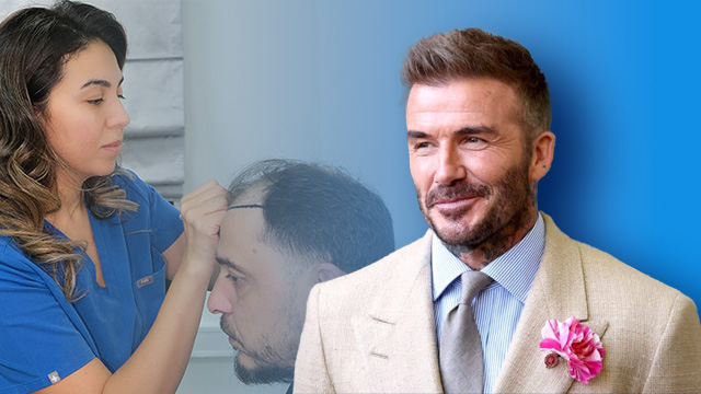 کاشت مو بازیگران