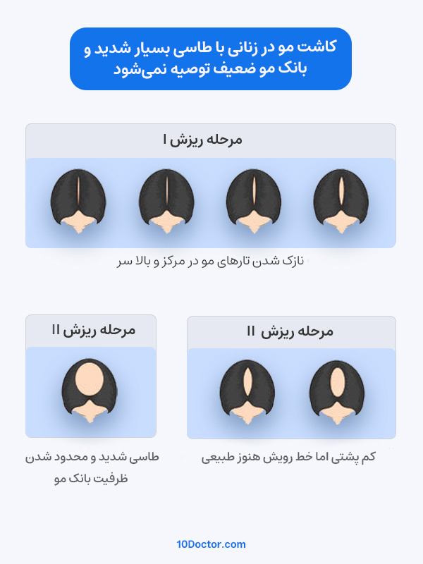 کاشت مو در زنانی با طاسی بسیار شدید و بانک مو ضعیف توصیه نمی‌شود.