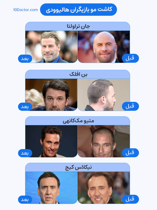 کاشت موی بازیگران هالیوود