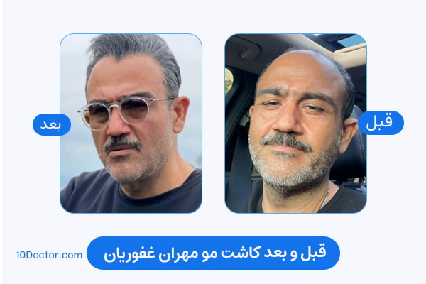 کاشت مو مهران غفوریان