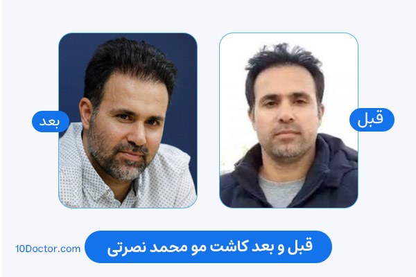 محمد نصرتی قبل کاشت مو - بعد از کاشت مو