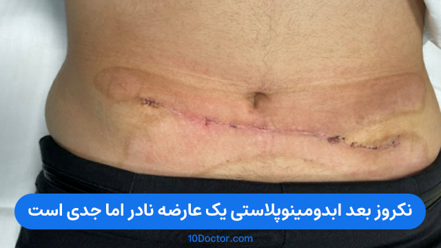 نکروز بعد ابدومینوپلاستی یک عارضه نادر اما جدی است.