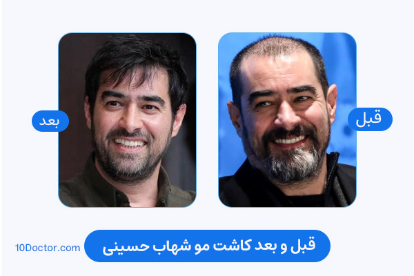 کاشت مو شهاب حسینی