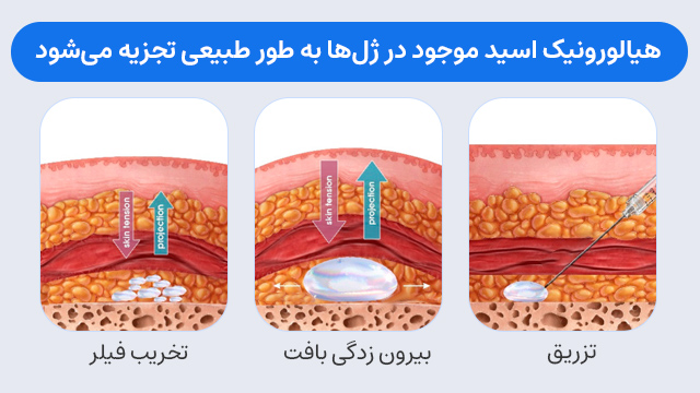 هیالورونیک اسید موجود در ژل‌ها به طور طبیعی تجزیه می‌شود.