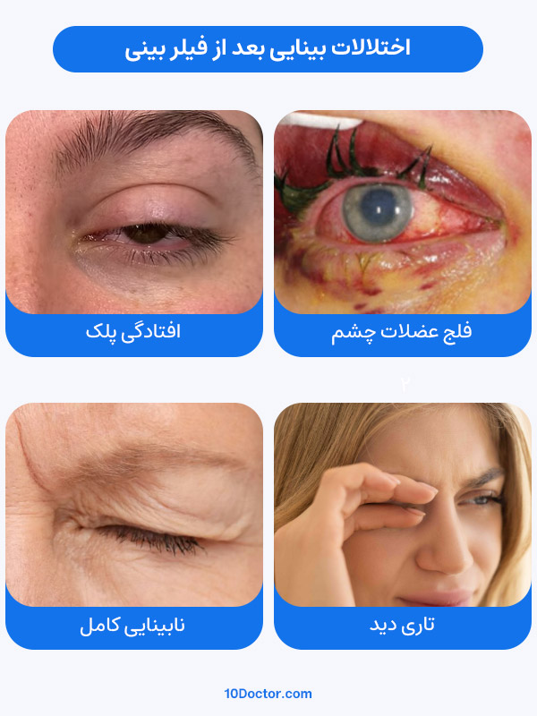 اختلالات بینایی بعد از فیلر بینی