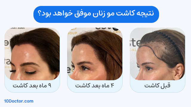 نتیجه کاشت مو زنان