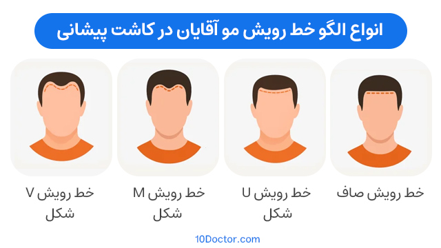 انواع الگو خط رویش مو در مردان برای کاشت مو پیشانی